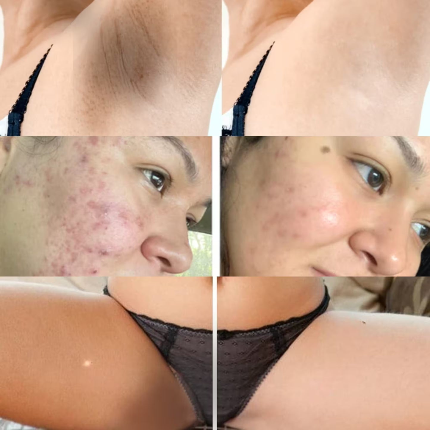 LumiSkin™ Set de 2 Jabones de cúrcuma y Acido Kojico, Adiós manchas oscura, Adiós Acné