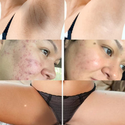 LumiSkin™ Set de 2 Jabones de cúrcuma y Acido Kojico, Adiós manchas oscura, Adiós Acné